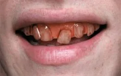 Rotten Goblin SFX Veneer Zähne